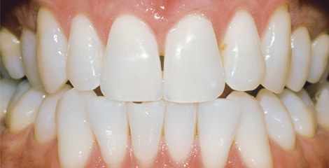 Reálni zuby po bělení s proužky Crest 3D White Professional Effects