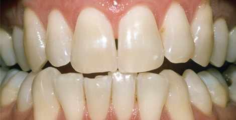 Reálni zuby před bělením s proužky Crest 3D White Professional Effects