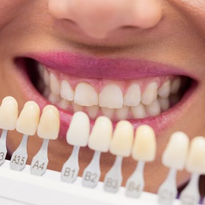Zjišťování odstínu zubů